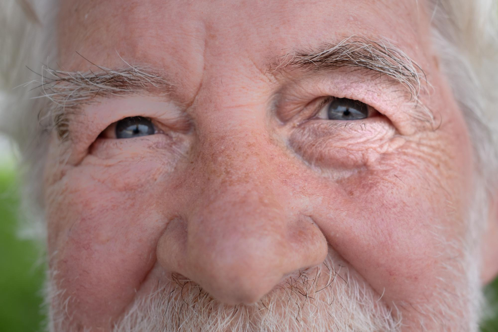 Under-Eye Bags with Lower Blepharoplasty