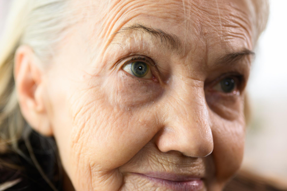 How To Fix Lagophthalmos After Blepharoplasty