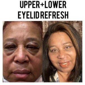 Upper And Lower Eyelid Refresh
