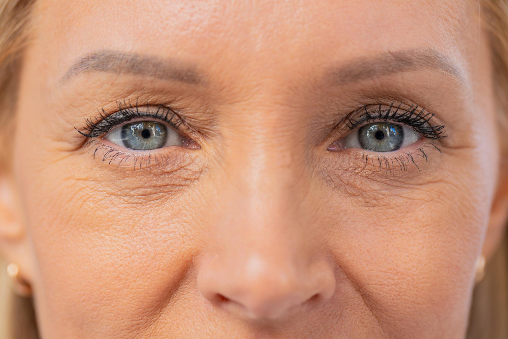 canthoplasty in Raleigh