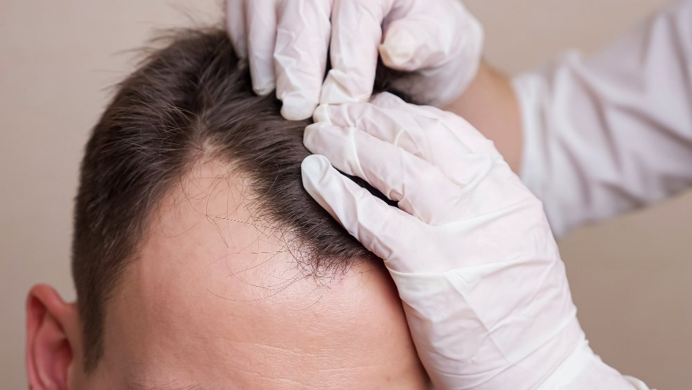 Hair Transplant in Raleigh, NC