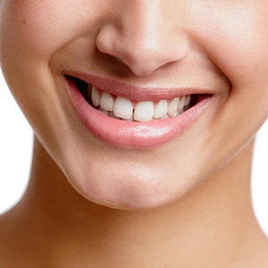 What Are Marionette Lines?