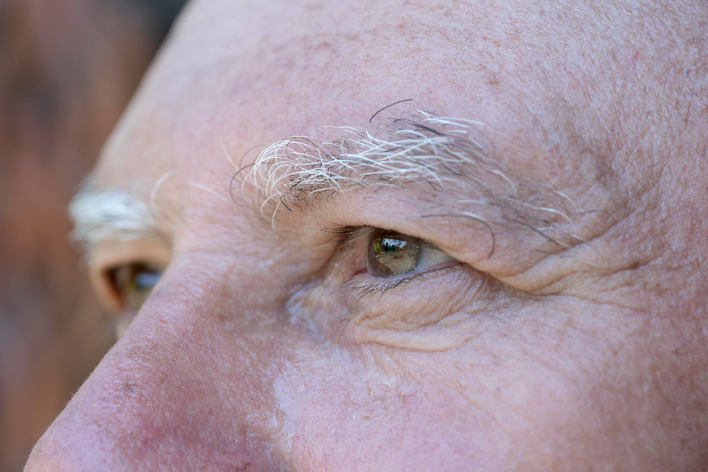 Blepharoplasty
