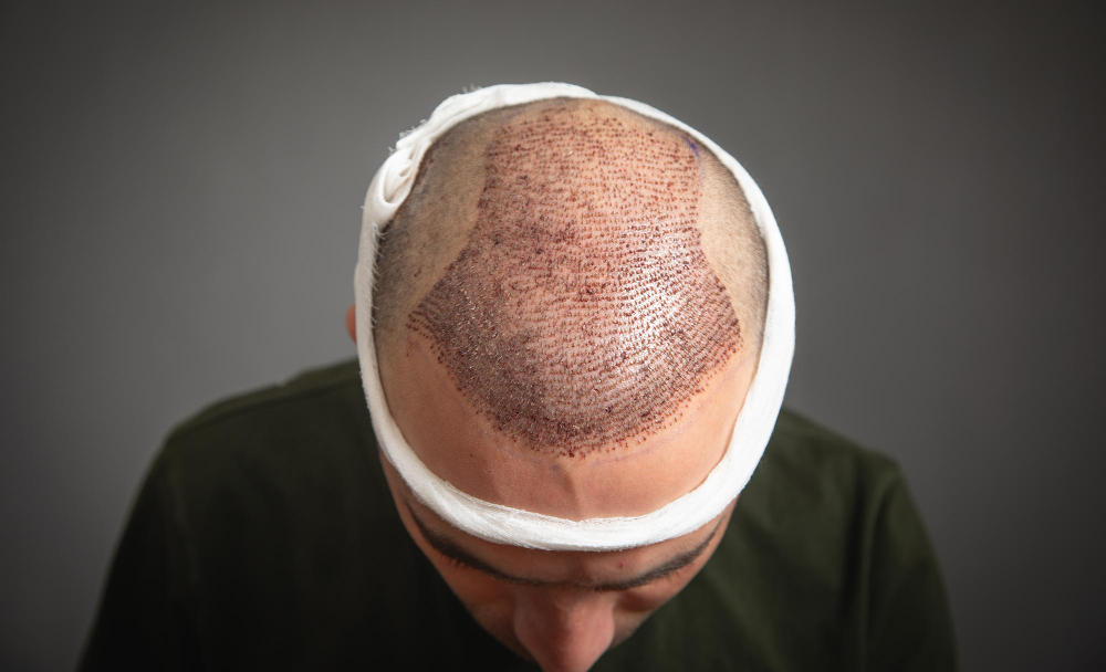 Does Hair In The Donor Area Grow Back After A Hair Transplant?