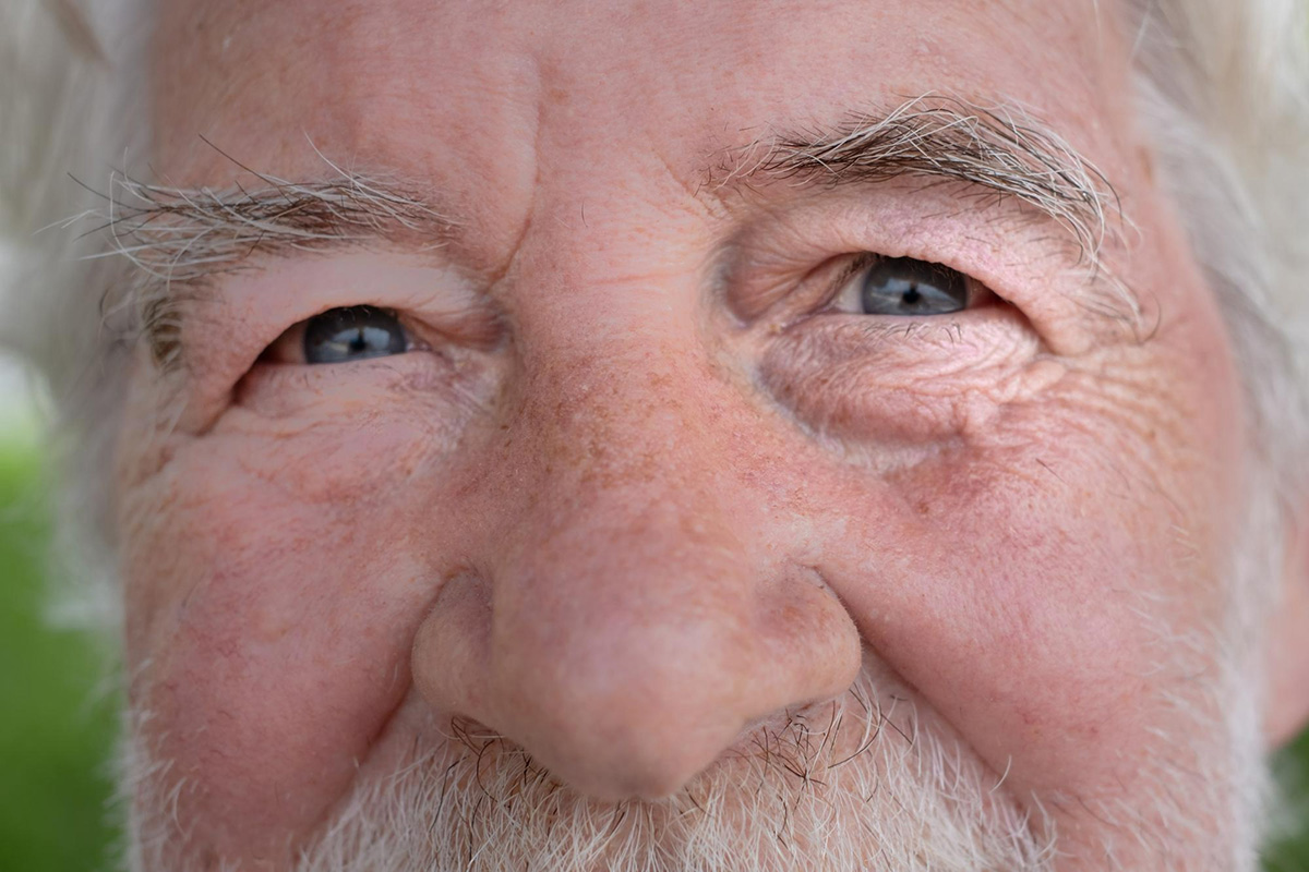 Upper Blepharoplasty Cost in Raleigh