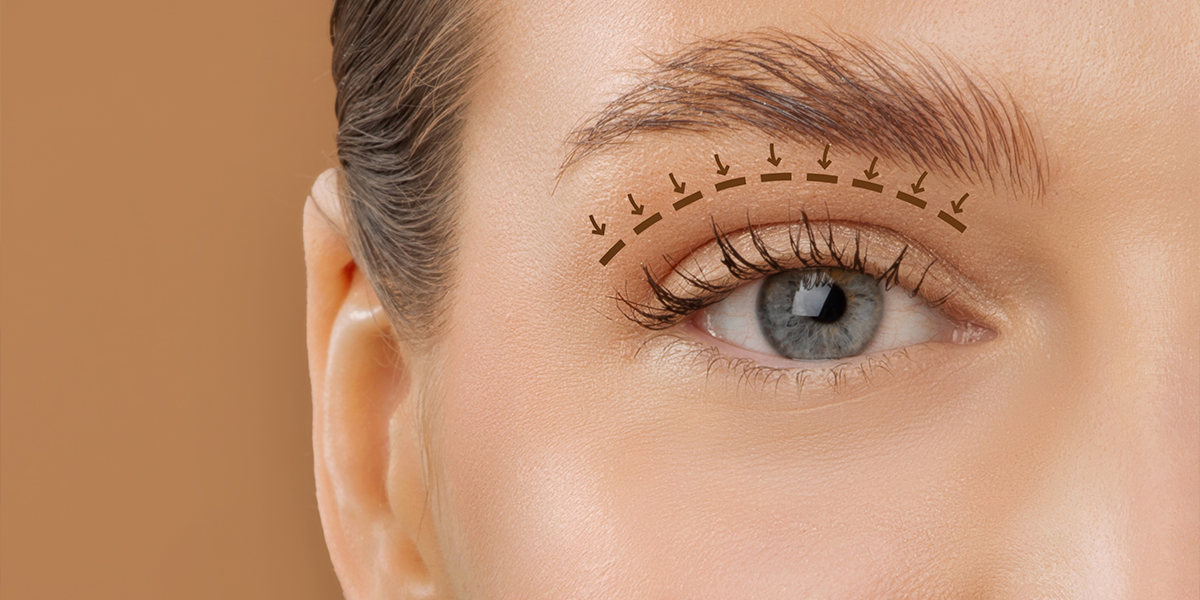 What Is Blepharoplasty and When Should You Consider It for Eyelid Sagging or Puffiness?