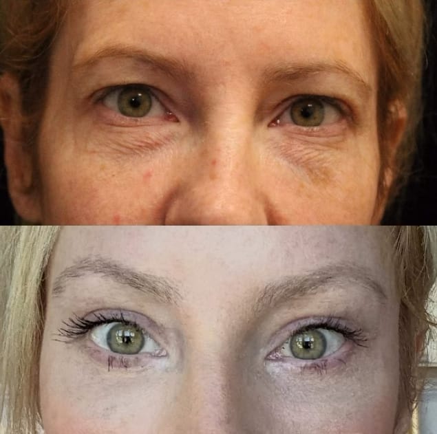 browlift-upper-blepharoplasty-jiya