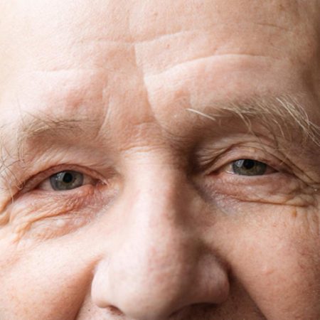 Difference between Canthopexy vs Canthoplasty