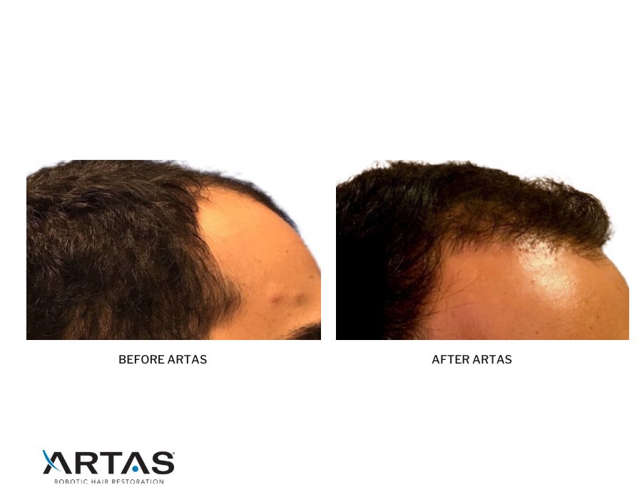 ARTAS Robotic Hair Restoration Raleigh, NC | Dr. Jindal