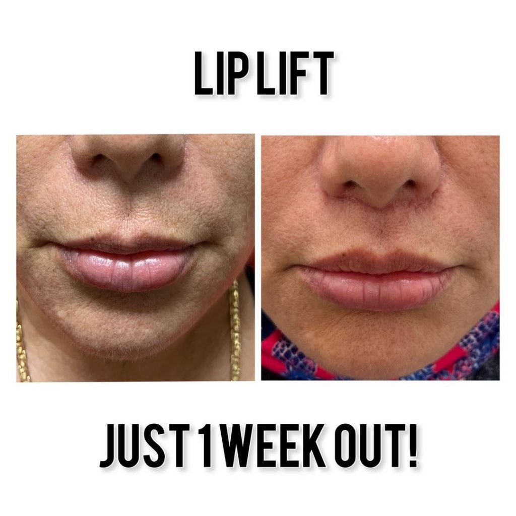 Best Plastic Surgeon Raleigh, NC Raleigh Plastic Surgery