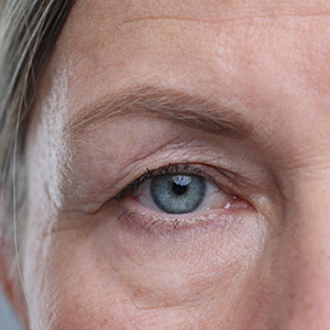 What Is a Mini Eye Lift?