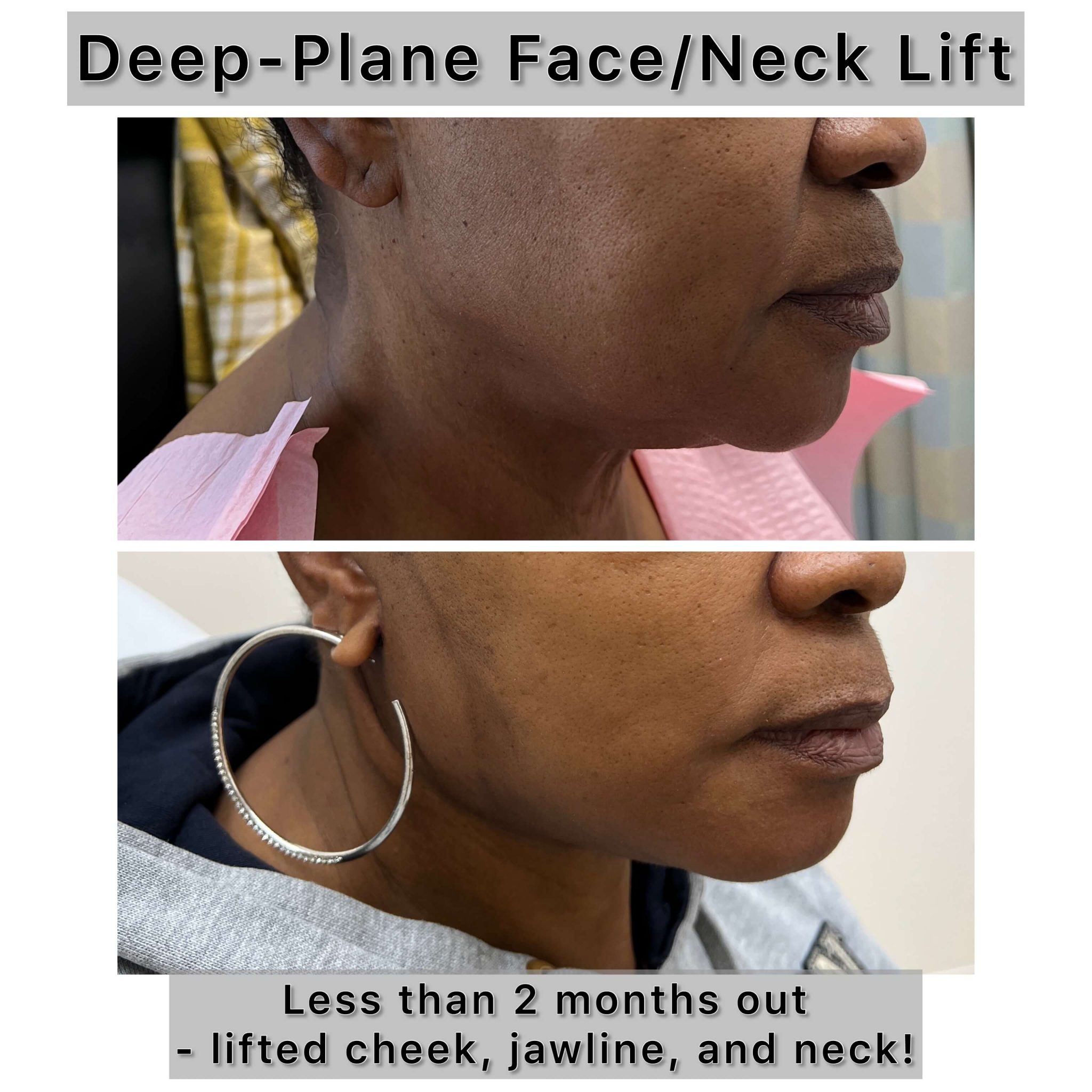 Deep Plane Facelift Raleigh, North Carolina Dr. Jindal