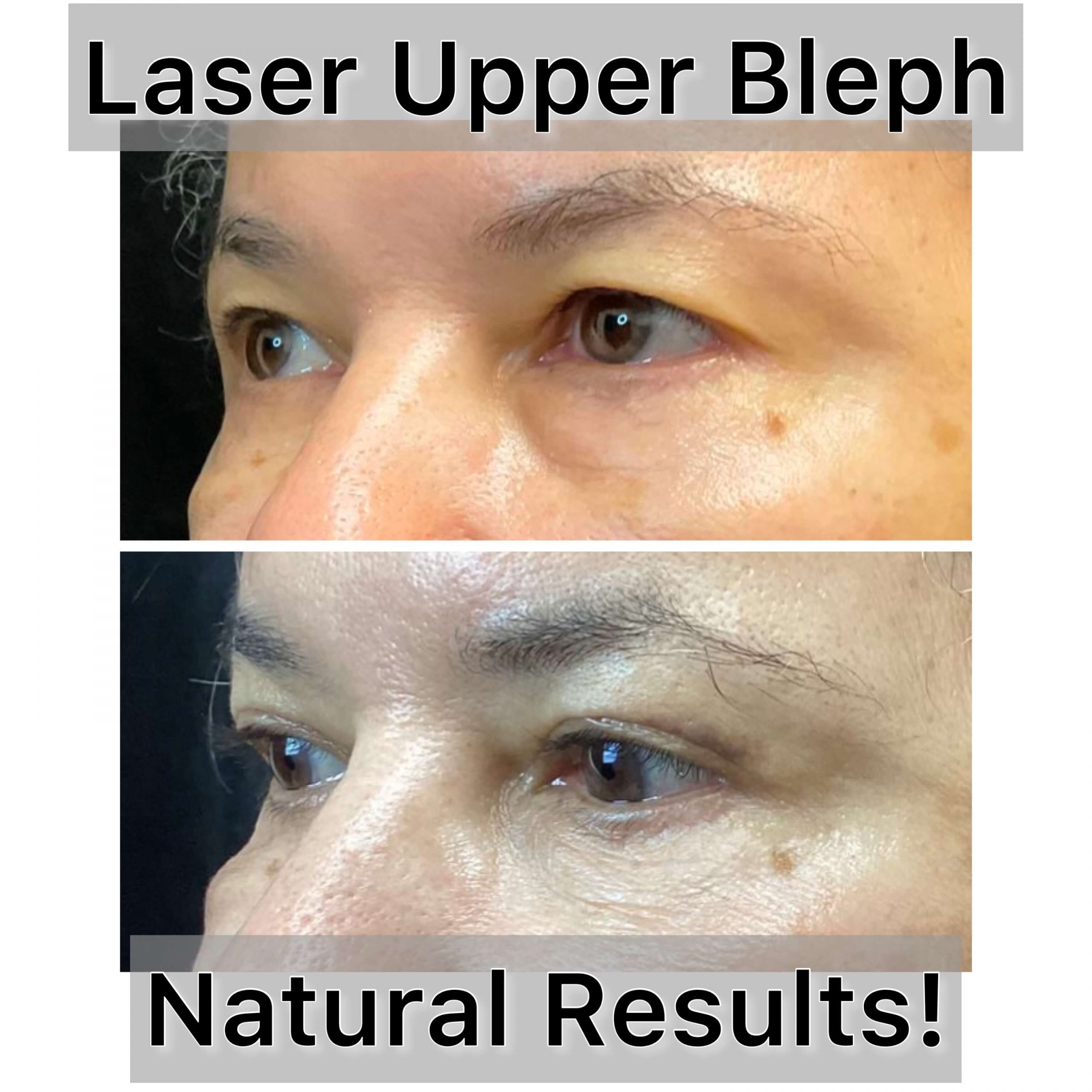 Upper Blepharoplasty | Upper Eyelid Fat Removal Raleigh, NC