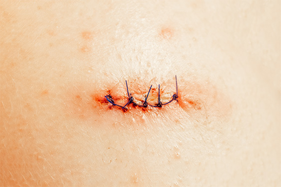 Ultraclear Surgical Scar Treatment Raleigh Nc Dr Jindal