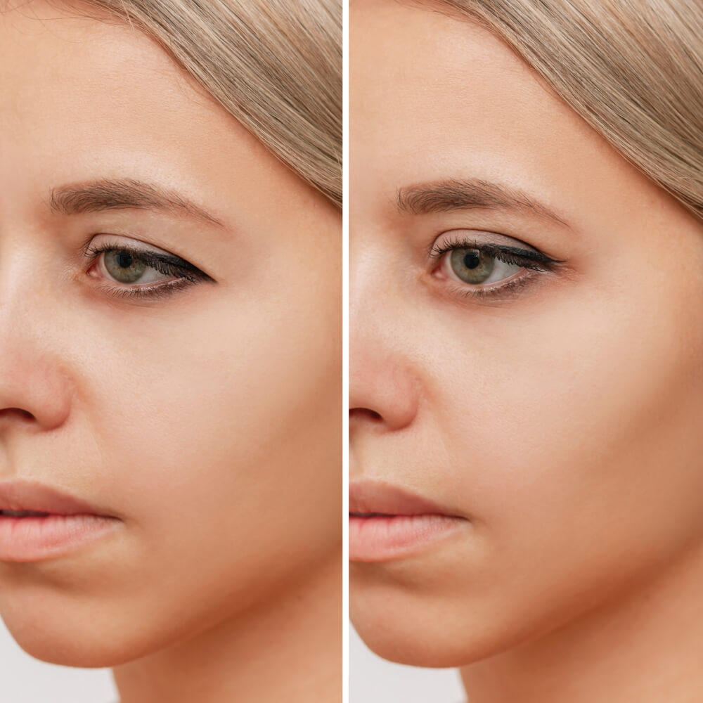 Upper Blepharoplasty | Upper Eyelid Fat Removal Raleigh, NC